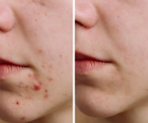 Cicatriz de Acne